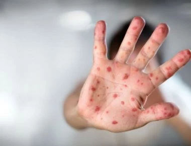 Συναγερμός! Τα κόκκινα σημάδια στα χέρια που «μυρίζουν θάνατο»